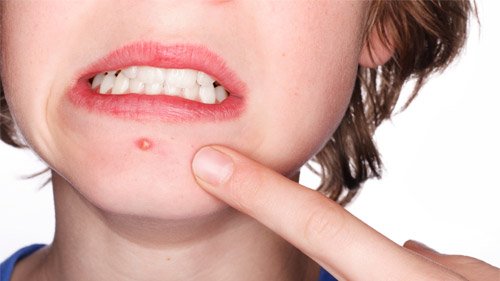 Muka Kamu Jerawatan? Nyebelin, kan? Ini 5 Tips yang Bisa Bantu Kamu Ngilanginnya