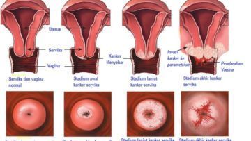 Perkenalkan: Kanker Serviks Pengancam Hidup Kaum Hawa. Kamu Harus Waspada!
