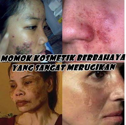 akibat kosmetik abal-abal 1