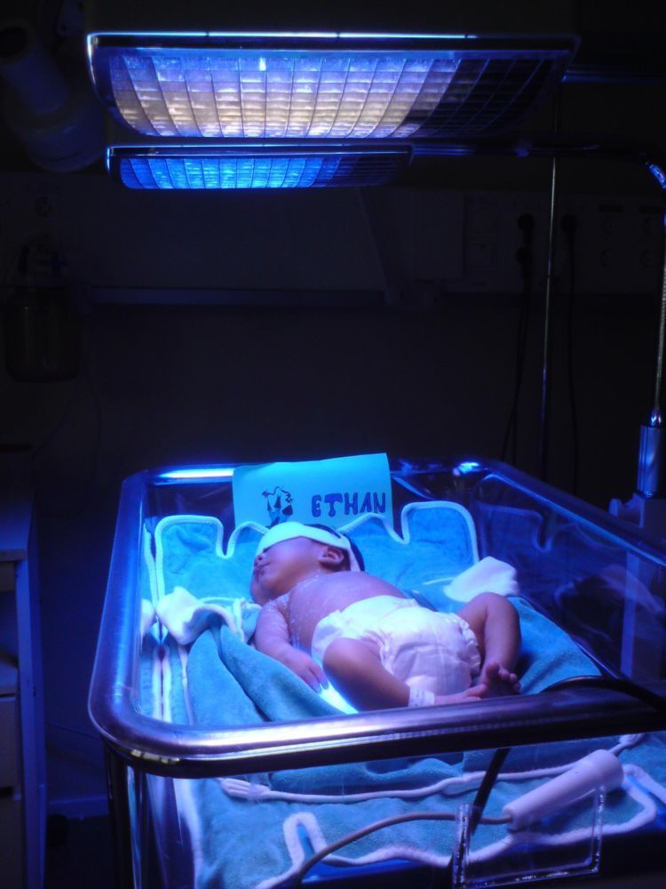 Pengobatan penyakit kuning pada bayi. Kasihan... :(