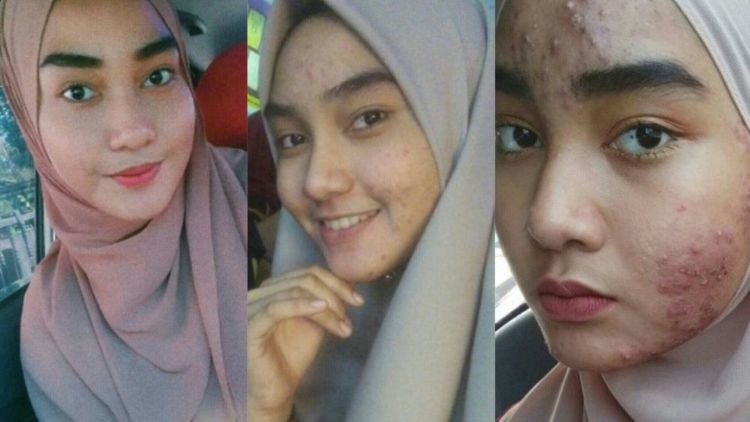 Stop Merawat Wajah dengan Produk Berbahan Kimia, Kalau Ogah Wajahmu Rusak Seperti Asmida!