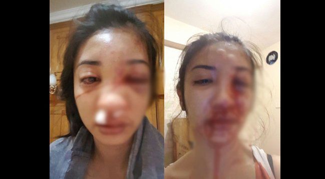 Kekerasan Dalam Hubungan yang Harus Segera Kamu Pahami, Jangan Sampai Seperti Kisah Saori Ishii 19 Saori pasca penganiayaan