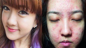 7 Kasus Kulit Rusak Akibat Pemakaian Make-Up. Jangan Sampai Kamu Mengalaminya!