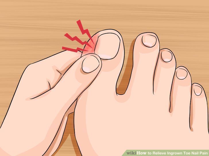 aid21961-728px-relieve-ingrown-toe-nail-pain-step-2-version-4