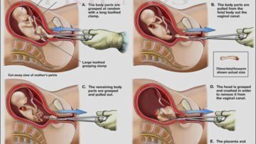 Setelah Melihat 5 Cara Aborsi yang Sadis Ini, Masih Kepikiran untuk ‘Membuat’ Bayi Terlalu Dini?