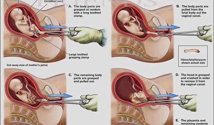 Setelah Melihat 5 Cara Aborsi yang Sadis Ini, Masih Kepikiran untuk ‘Membuat’ Bayi Terlalu Dini?