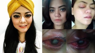 Mata Terserang Bakteri Ganas Akibat Ceroboh Pakai Softlens. Please, Kamu yang Hati-hati Ya!