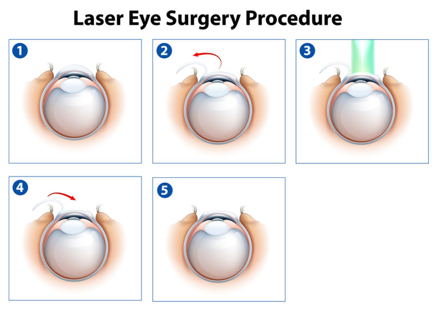 Mengenal Operasi Lasik Mata untuk Menajamkan Penglihatan. Mata Minus, Plus, atau Silinder Bisa