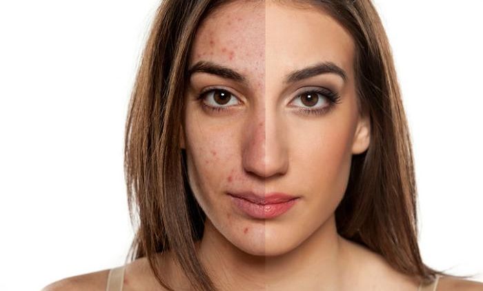 Ada Terobosan Baru Buat yang Suka Jerawatan! Lupakan Skin Care Mahal, Kini Ada Vaksin Anti Jerawat