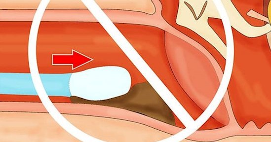 Banyak yang Salah Kaprah, Ternyata Bersihin Telinga Pakai Cotton Bud Itu Bahaya. Baca Deh Faktanya!