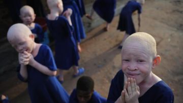 Kisah Sedih Orang Albino di Afrika, Diburu dan Dibunuh Karena Keunikannya. Ini 8 Faktanya
