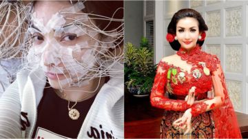 Roro Fitria Dikritik Keras Oleh Warganet karena Pamerkan Gigi Baru Hasil Operasi Seharga 200 Juta
