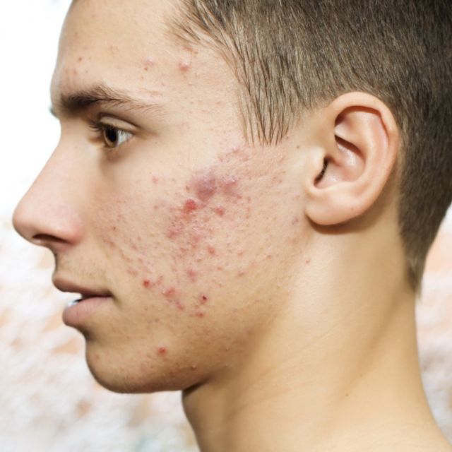 acne