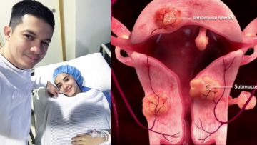 Waspada Endometriosis dan Fibroid Seperti yang Dialami Oleh Zaskia Sungkar. Ini Penjelasannya!