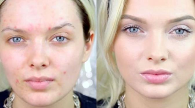 6 Tips Makeup untuk Kamu yang Berjerawat