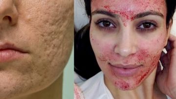 Menghilangkan Bopeng dan Bekas Jerawat Kini Bukan Lagi Mimpi. Vampire Facial Salah Satu Solusinya!