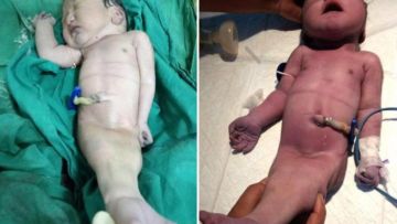 Bayi di India Lahir dengan Kaki Menyatu Mirip Putri Duyung. Ternyata Sindrom Ini Penyebabnya