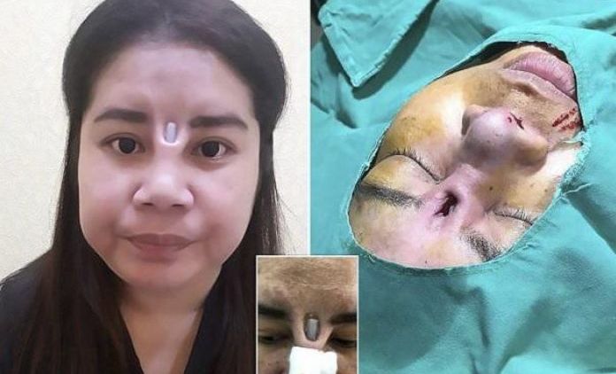 Pengen Mancung Malah Kena Apes. Sisi Gelap Operasi Plastik Thailand yang Bikin Bergidik