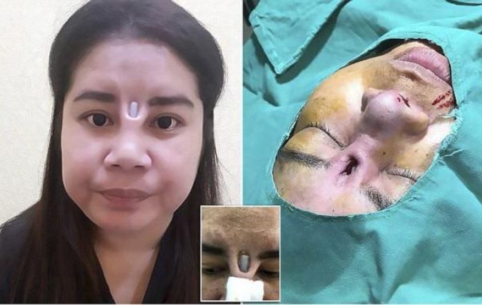Pengen Mancung Malah Kena Apes. Sisi Gelap Operasi Plastik Thailand yang Bikin Bergidik