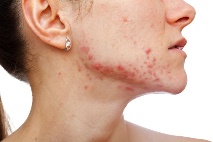 6+ Tips Ampuh Hilangkan Jerawat Level Frustasi dengan Cepat. Simak dan Terapkan dengan Cermat Ya!