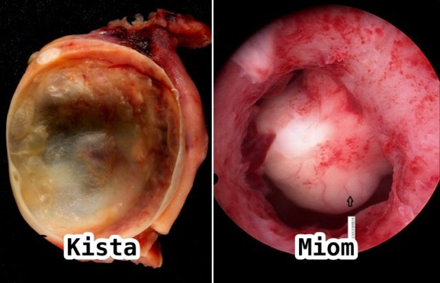 perbedaan kista dan miom