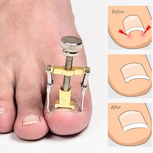 7 Tips yang Perlu Kamu Ketahui Untuk Mengobati Cantengan Pada Kuku Jari Tangan Ataupun Kaki
