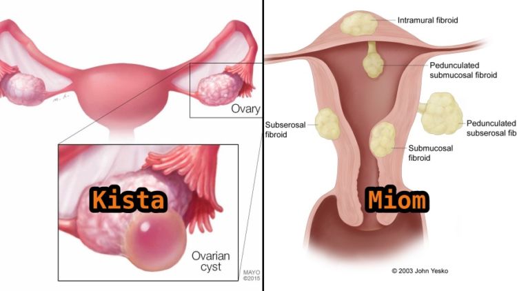 Perbedaan Kista dan Mioma, Gangguan Umum pada Organ Reproduksi Wanita