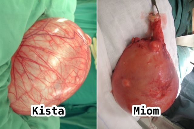 perbedaan kista dan miom