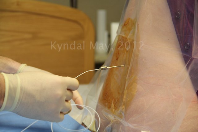 7 Fakta Penting Tentang Epidural, Bius Penahan Rasa Sakit untuk Ibu Melahirkan!