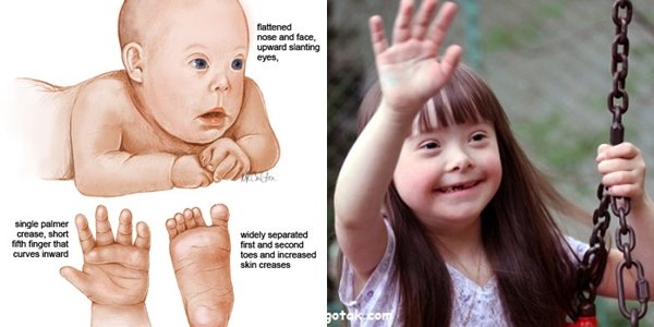 14 Fakta Down Syndrome yang Bukan Cuma Para Ibu, Tapi Semua Orang Wajib Tahu #LotsOfSocks