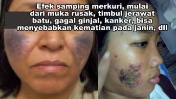 Nggak Boleh Sembarangan! Inilah Alasan Kenapa Obat Jerawat Pilihanmu Harus Punya Izin BPOM