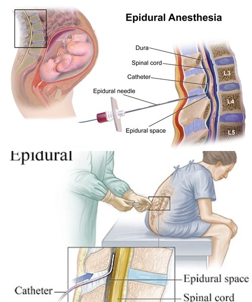 7 Fakta Penting Tentang Epidural, Bius Penahan Rasa Sakit untuk Ibu Melahirkan!