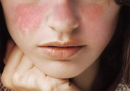 Terserang Systemic Lupus Erythematosus Atau yang Lebih Dikenal Dengan Lupus? Ketahui Tandanya Yuk!
