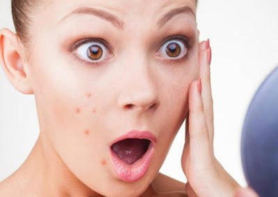 5 Cara Alami Ini Ampuh Menghilangkan Jerawat Membandel