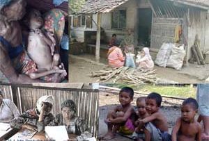 Dampak Kemiskinan bagi Kejadian Gizi Buruk pada Generasi Bangsa yang Tak Terselesaikan