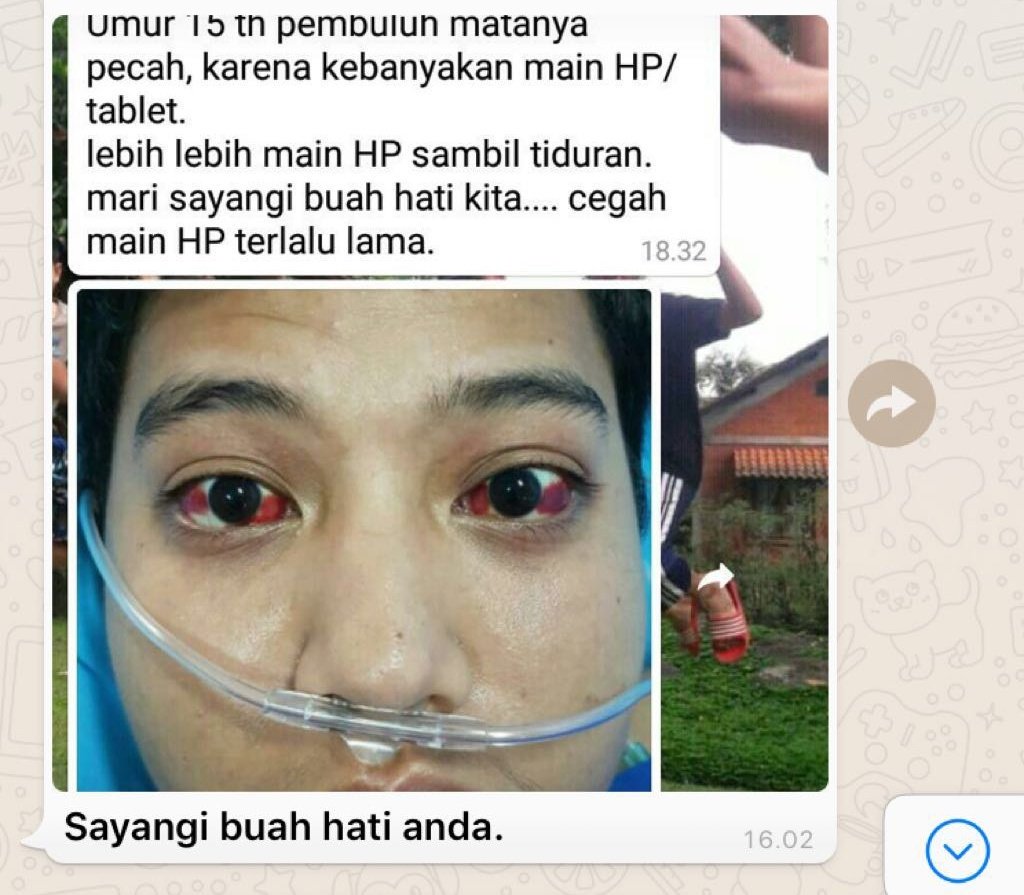 4 Kondisi yang Sebabkan Mata Merah Layaknya Berlumuran Darah. Sebenarnya Nggak Sebahaya itu Kok 11 4 Kondisi yang Sebabkan Mata Merah Layaknya Berlumuran Darah. Sebenarnya Nggak Sebahaya itu Kok