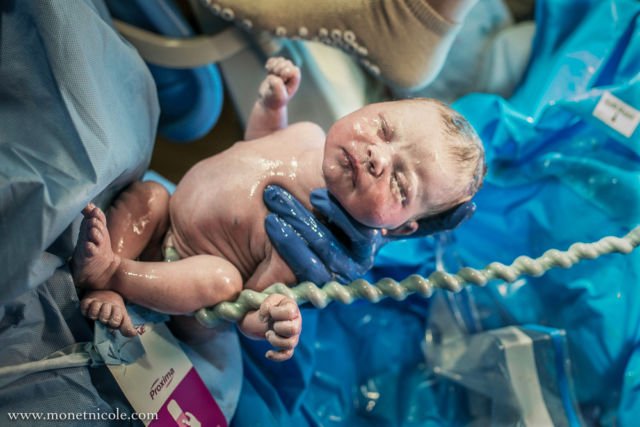 Gambaran Tali Pusar Bayi Baru Lahir yang Memikat, Usai Dipotong Pun Perlu Dirawat
