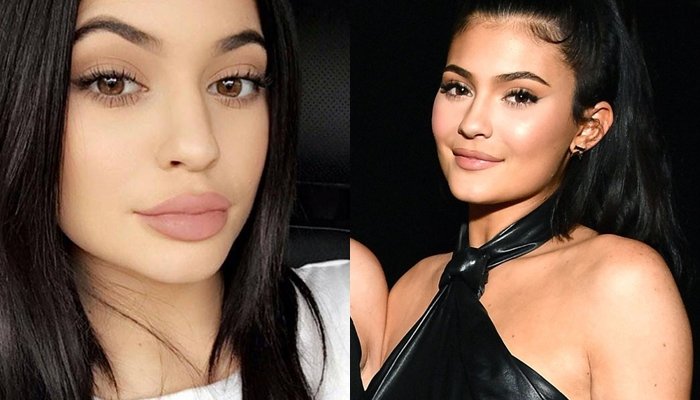Ratu Kosmetik Hits, Kylie Jenner Resmi Lepas Filler Bibir. Pahami 5 Hal Ini Buat yang Penasaran dengan Prosedurnya