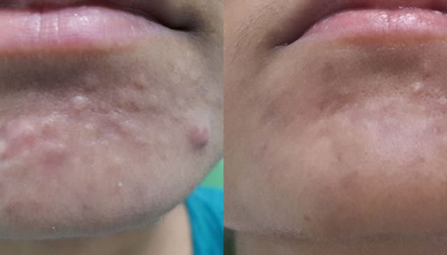 7 Kondisi Kulit Ini Sering Kita Anggap Jerawat. Padahal Bukan Lho, Cuma Mirip Saja 19 7 Kondisi Kulit Ini Sering Kita Anggap Jerawat. Padahal Bukan Lho, Cuma Mirip Saja