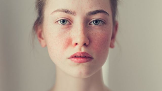 7 Kondisi Kulit Ini Sering Kita Anggap Jerawat. Padahal Bukan Lho, Cuma Mirip Saja 15 7 Kondisi Kulit Ini Sering Kita Anggap Jerawat. Padahal Bukan Lho, Cuma Mirip Saja