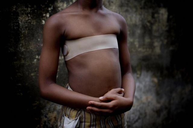 5 Alasan Remaja Perempuan di Kamerun Terpaksa Menyetrika Payudaranya. Kisahnya Sedih Banget