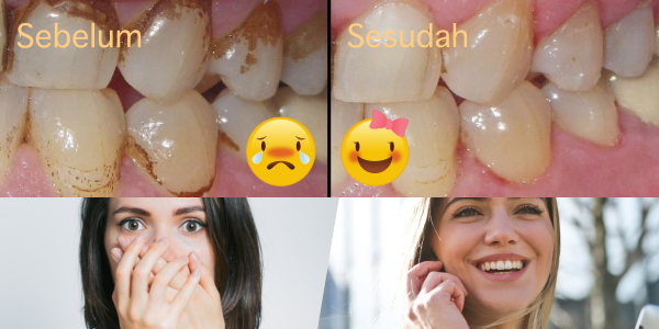5 Alasan Kenapa Kamu Nggak Boleh Malas Scaling Karang Gigi. Bukan Cuma Bau Mulut, Penyakit Jantung Pun Bisa Mengintai