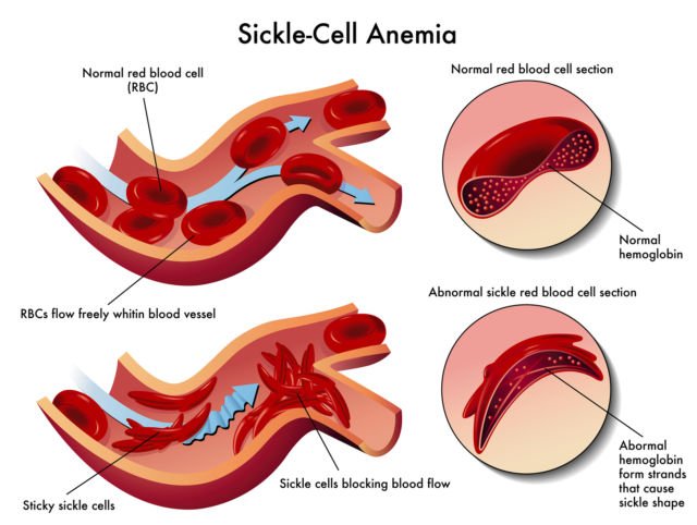 stroke di usia muda