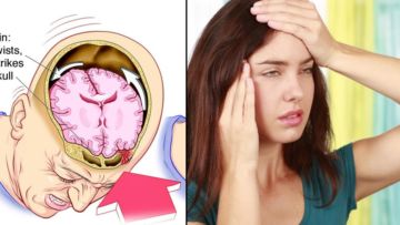 5 Pemicu Penyakit Stroke di Usia Muda. Sering Migrain Salah Satunya