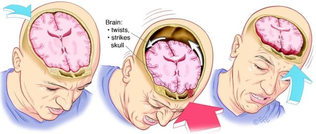 stroke di usia muda