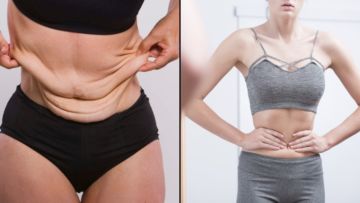 6 Pencegahan biar Kulitmu Nggak Bergelambir Setelah Susut Berat Badan