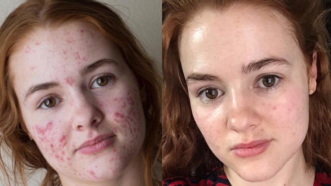 8 Tips Acne Diet yang Sebaiknya Jangan Dilewatkan. Jerawat Bakal Hilang!