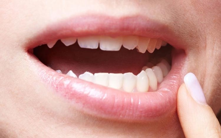 7 Cara Menghilangkan Sariawan Secara Cepat dan Alami Agar Tidak Lama-Lama Merusak Selera Makan Kamu