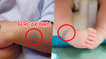 Mengenal Mongolian Spot, Bercak Biru Kehijauan yang Kerap Ditemui di Pantat Bayi. Bahayakah?