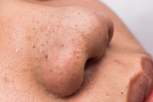 fakta pore pack bikin komedo